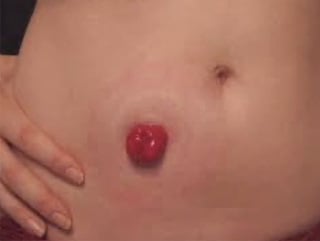 Ostomy_stoma healthy Sec Article